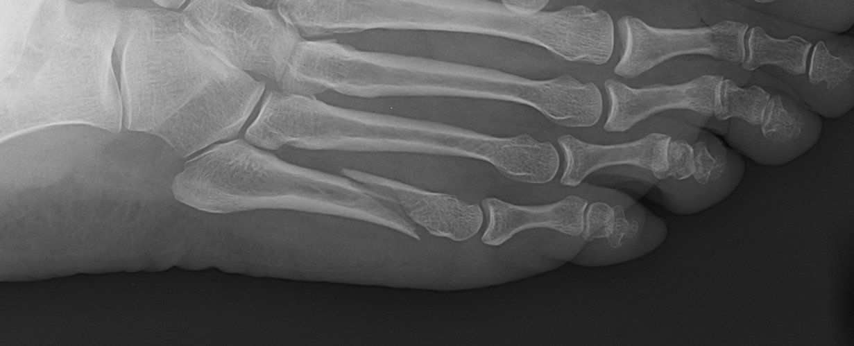 Th Metatarsal Fracture Dr Ben Beamond Adelaide